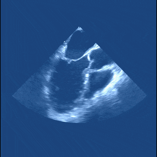Dobogó szív (ultrahang)