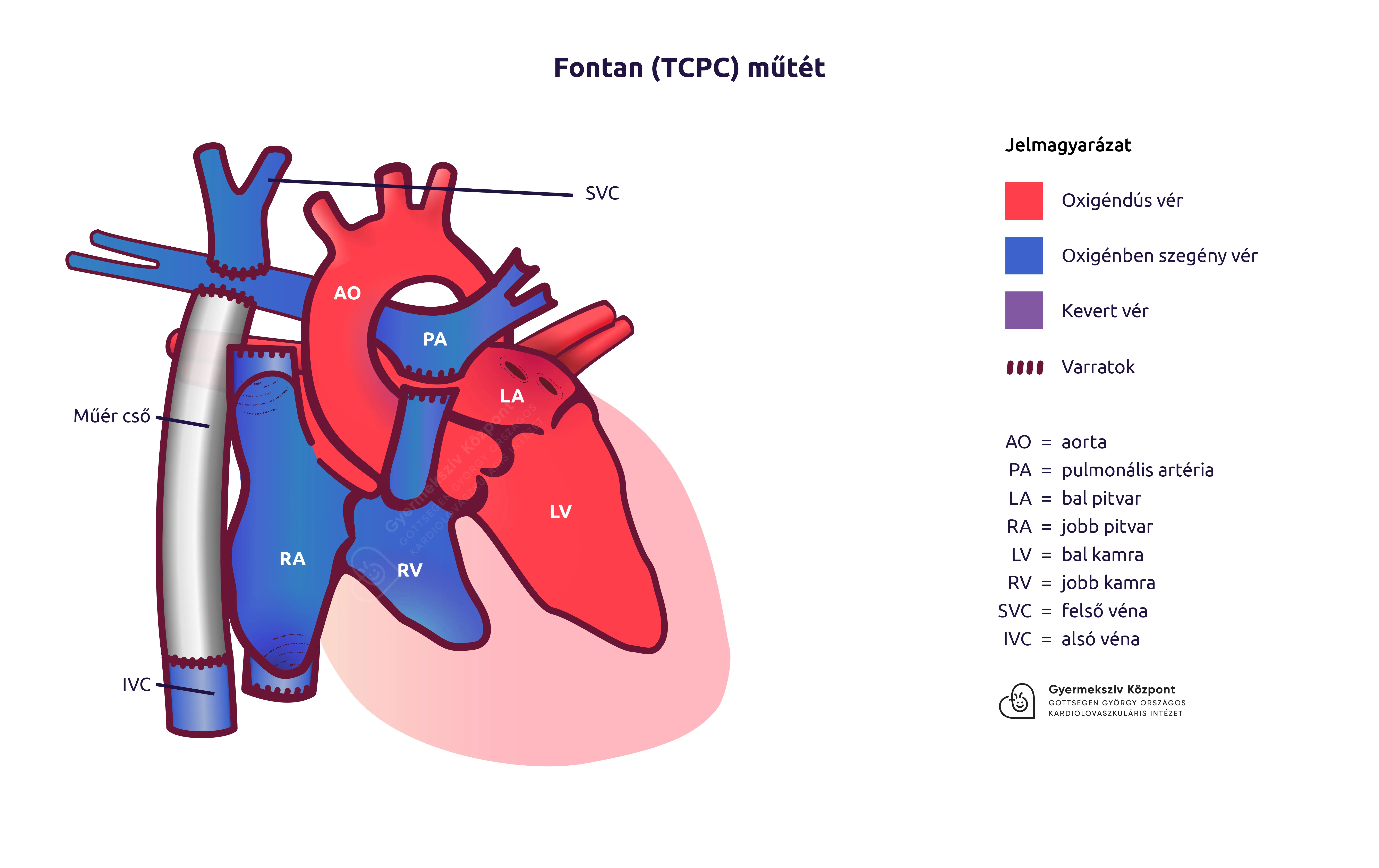Fontan (TCPC) műtét illusztráció