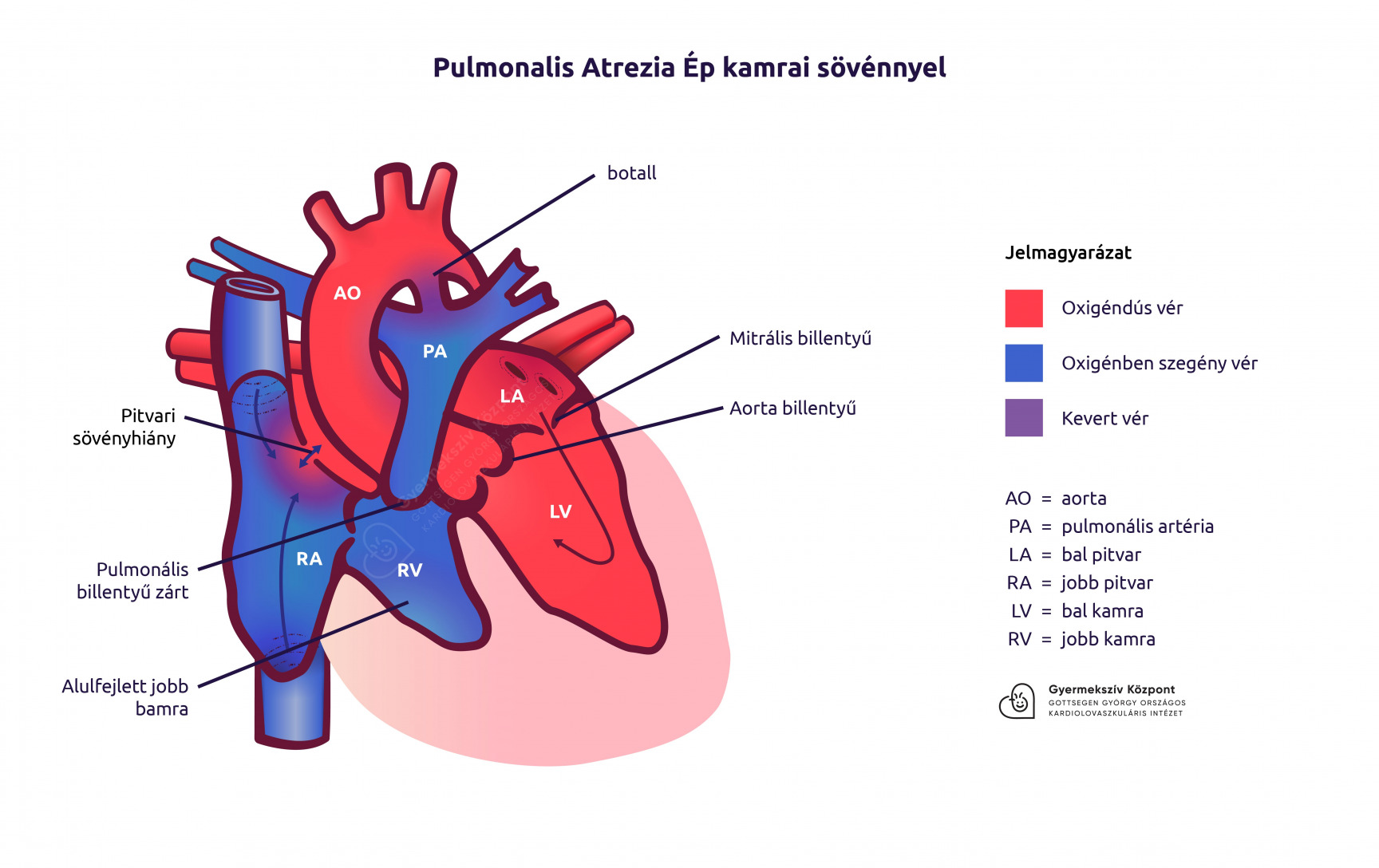 Pilmonalis Atrezia ép kamrai sövénnyel rajz