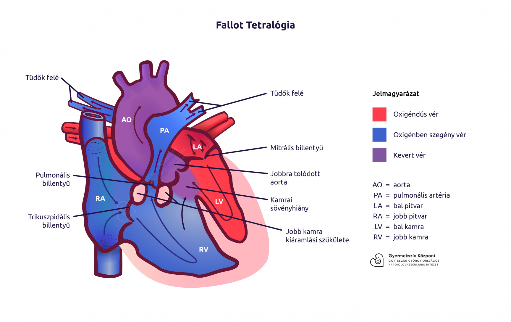 Fallot tetralogia rajz