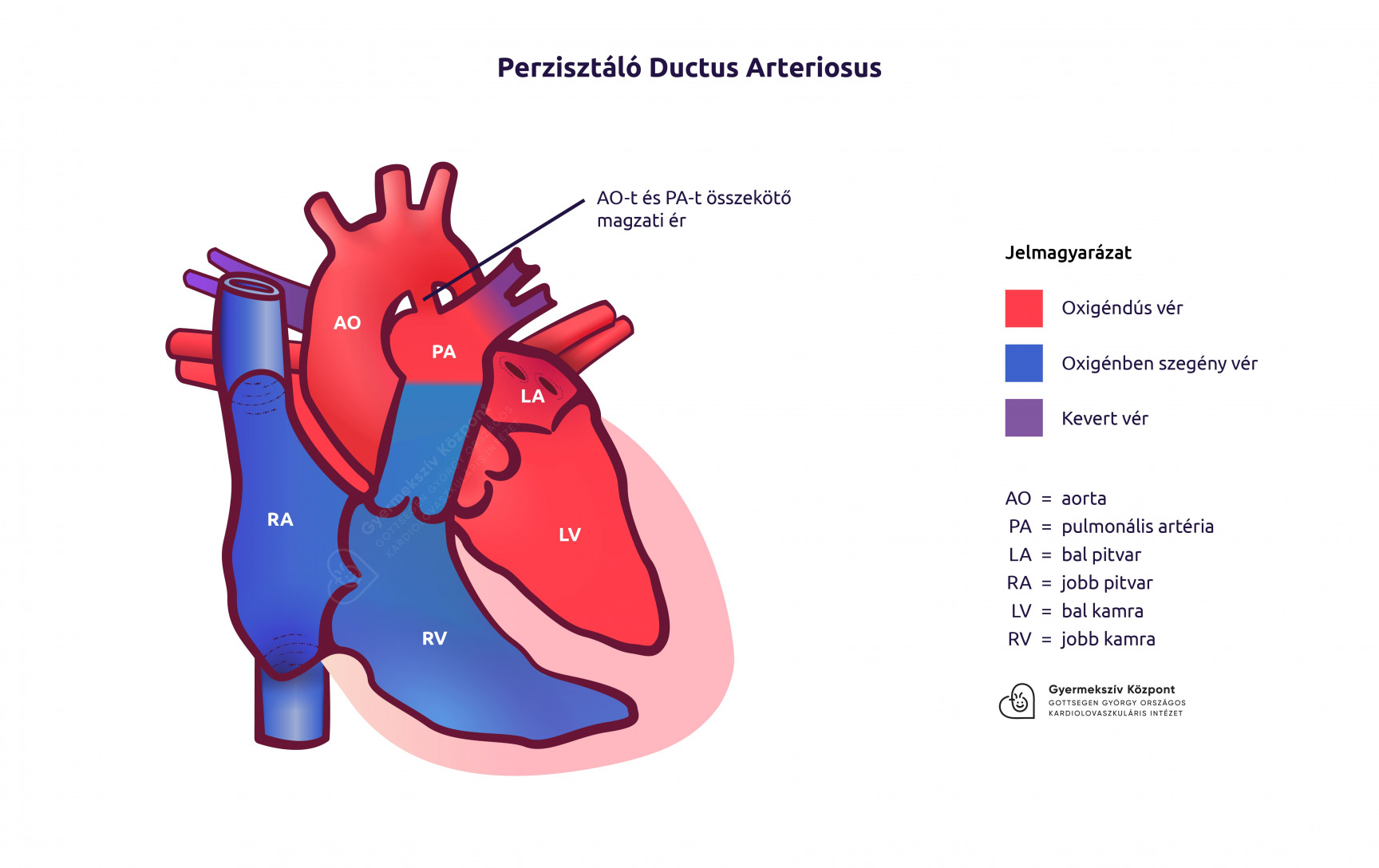 Perzisztáló ductus arteriosus rajz