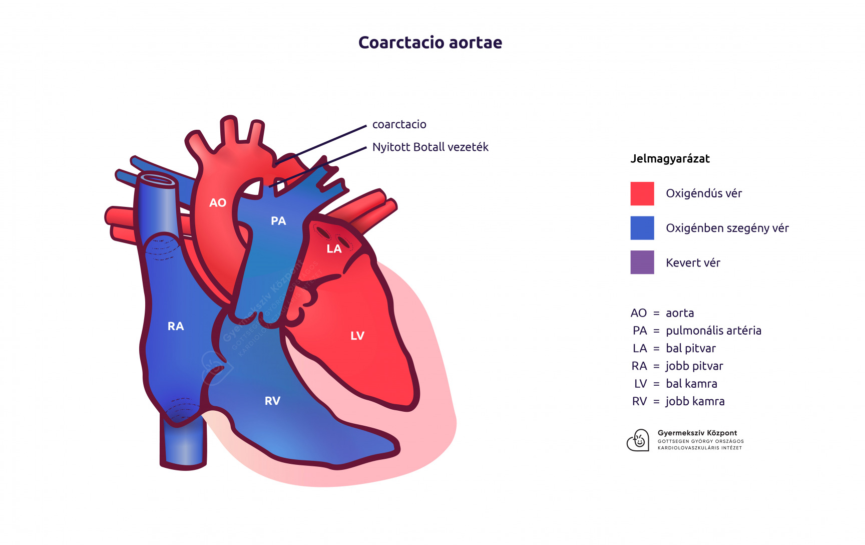 Coarctacio aortae rajz